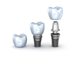 replace missing teeth with dental implants in Severna Park, Maryland