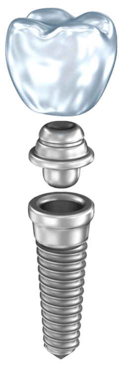 Affordable Dental Implants in Severna Park, Maryland
