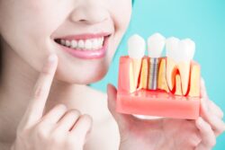dental implants tooth replacement