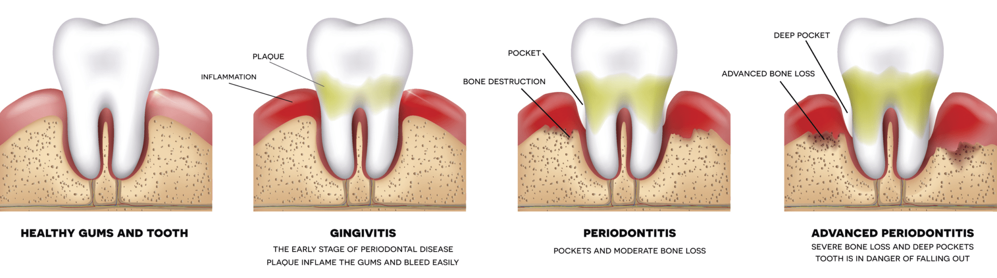 periodontal therapy severna park md