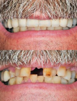 missing teeth replacement severna park md