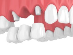 Traditional Dental Bridge Placement